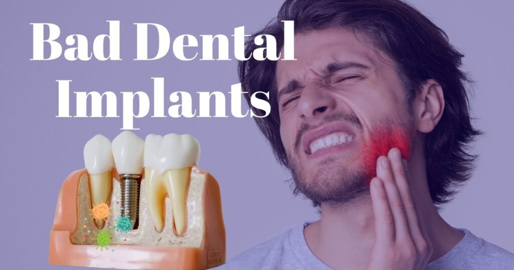 Bad Dental Implants