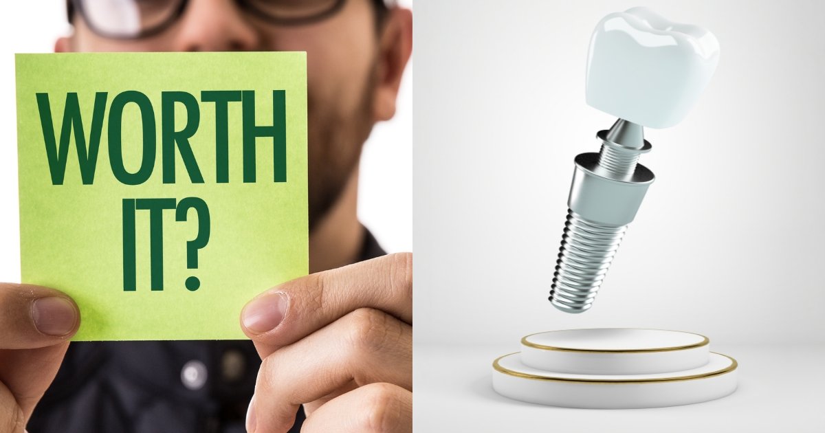 Full Mouth Dental Implants Cost in 2025: What You’ll Really Pay & How to Save Big 12 Are full mouth dental implants worth it