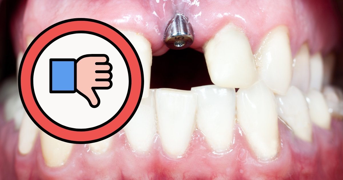 Full Mouth Dental Implants Cost in 2025: What You’ll Really Pay & How to Save Big 13 What is the downside to dental implants