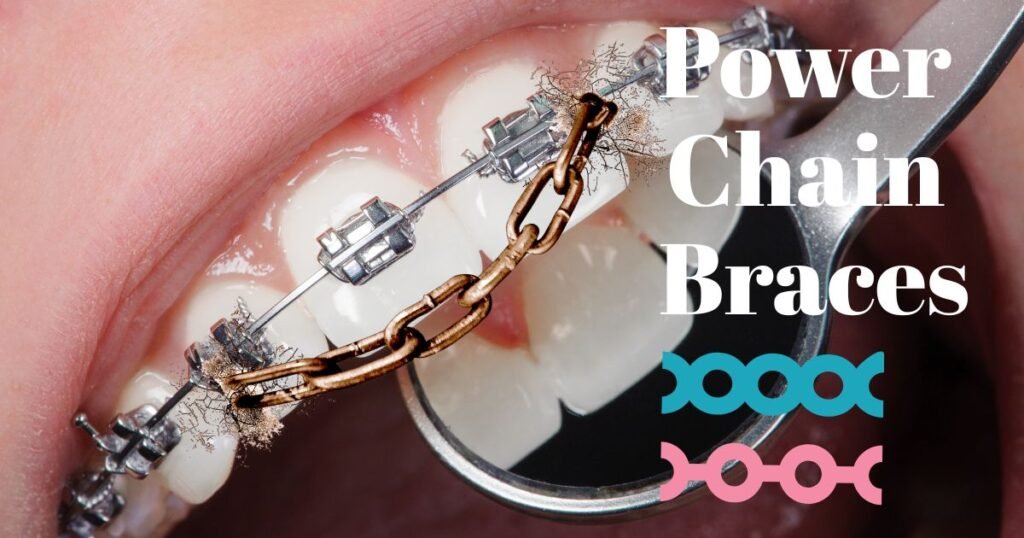 Power Chain Braces