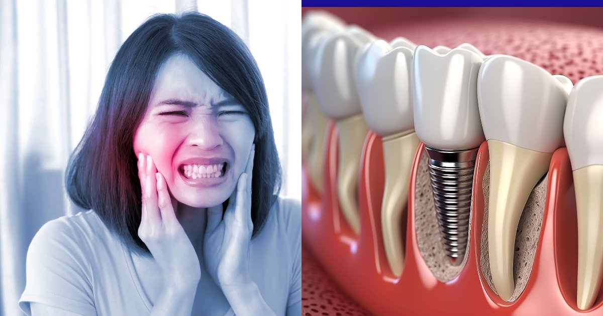 Full Mouth Dental Implants Cost in 2025: What You’ll Really Pay & How to Save Big 14 How painful is a full set of implants