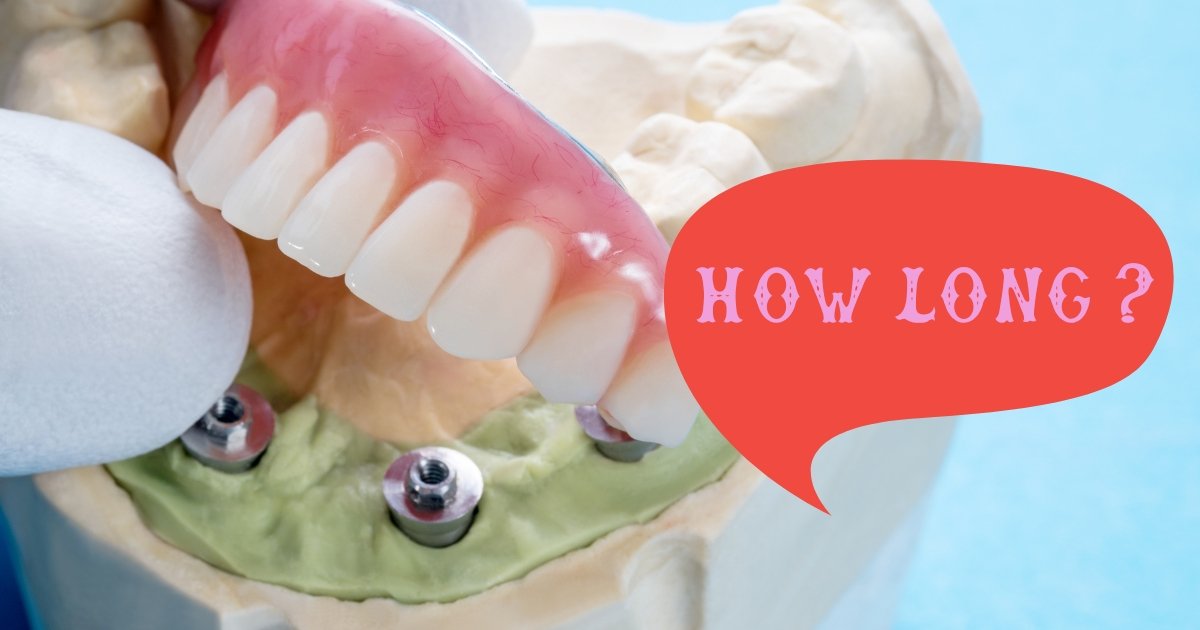 Full Mouth Dental Implants Cost in 2025: What You’ll Really Pay & How to Save Big 15 How long does it take to get full mouth dental implants