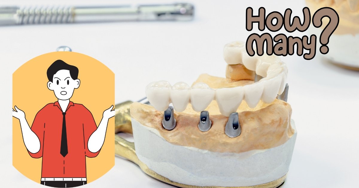 Full Mouth Dental Implants Cost in 2025: What You’ll Really Pay & How to Save Big 17 How many teeth do you get with full dental implants