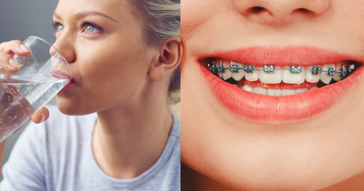 Invisalign vs Braces? The Ultimate Guide to Choosing the Right Option in 2025! 18 Can you drink with Invisalign?