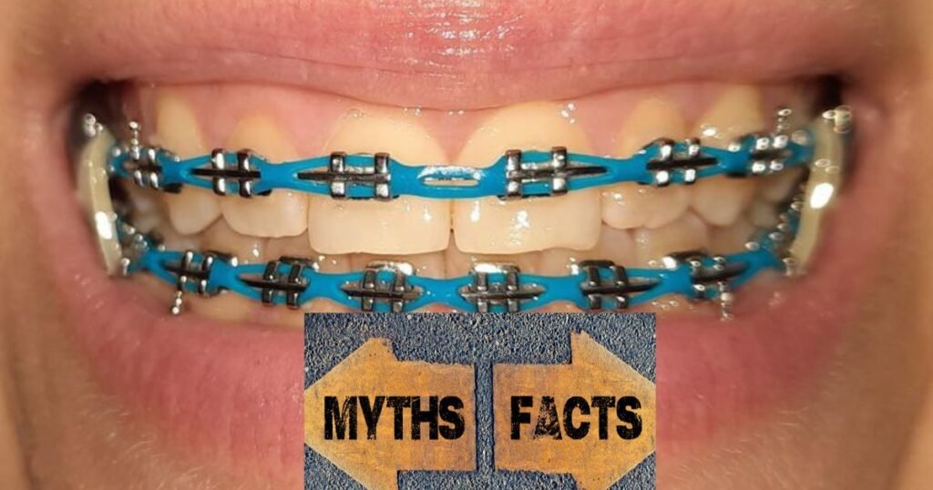 Power Chain Braces: uLTIMATE GUIDE 2025 6 Power Chain Braces