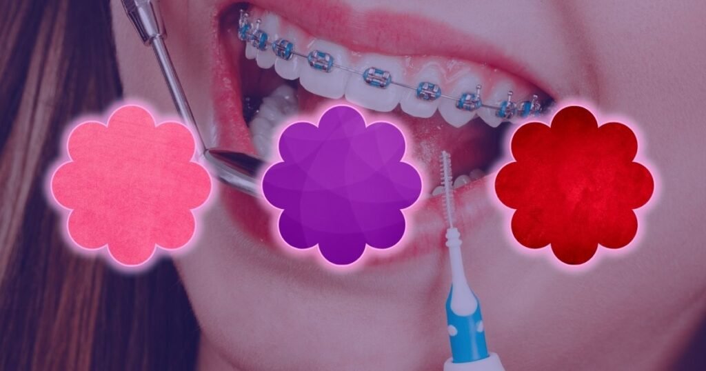 Best Braces Colors for Girls in 2025: Cute, Trendy & Stylish Choices 3 Best Braces Colors for Girls