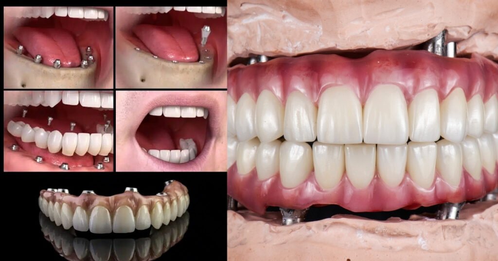 Full Mouth Dental Implants Cost in 2025: What You’ll Really Pay & How to Save Big 3 Full Mouth Dental Implants Cost