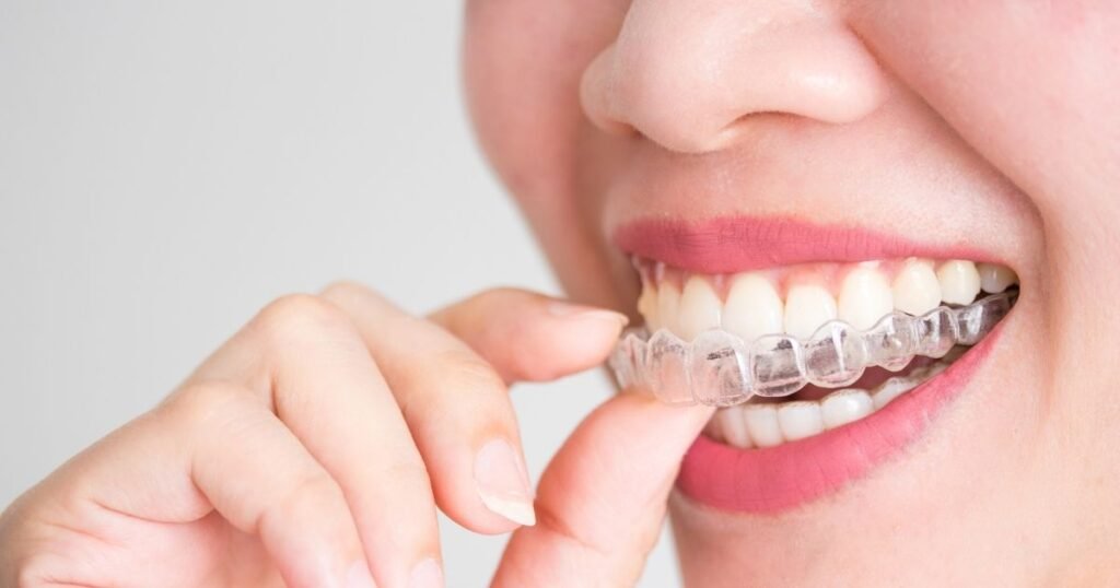 Invisalign vs Braces? The Ultimate Guide to Choosing the Right Option in 2025! 3 Invisalign vs Braces