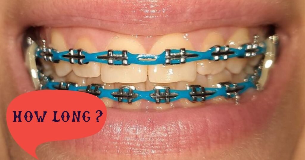 Power Chain Braces: uLTIMATE GUIDE 2025 8 Power Chain Braces
