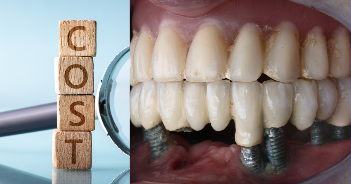 Full Mouth Dental Implants Cost in 2025: What You’ll Really Pay & How to Save Big 22 What is the average cost of a full set of dental implants