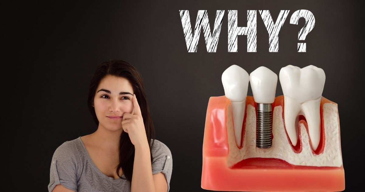 Full Mouth Dental Implants Cost in 2025: What You’ll Really Pay & How to Save Big 23 Why do full mouth dental implants cost so much