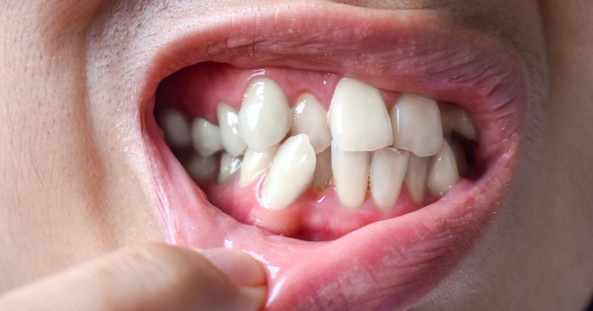 Invisalign vs Braces? The Ultimate Guide to Choosing the Right Option in 2025! 28 What teeth are too bad for Invisalign