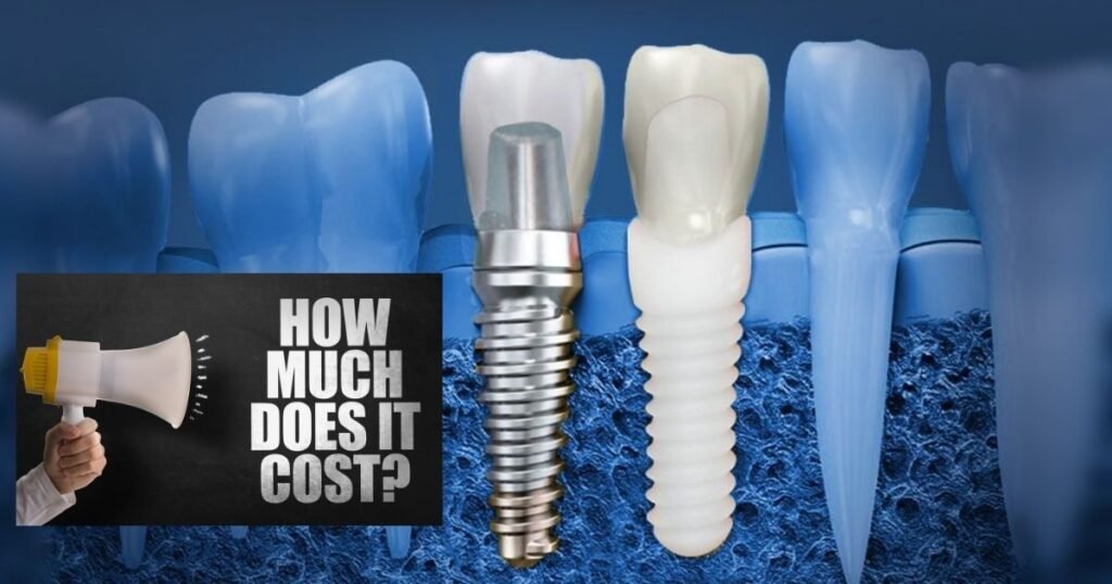 Zirconia Dental Implants Cost