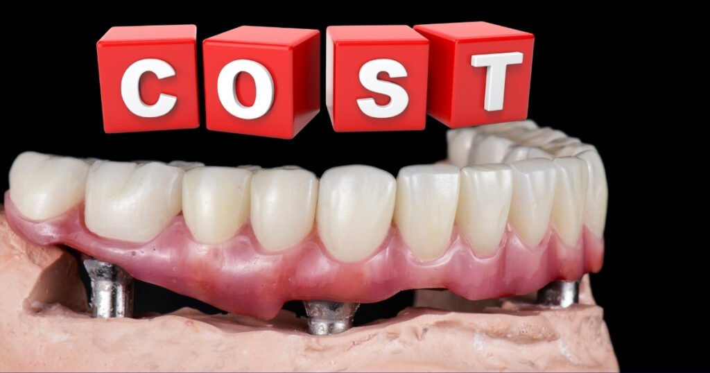 Full Mouth Dental Implants Cost in 2025: What You’ll Really Pay & How to Save Big 4 Full Mouth Dental Implants Cost