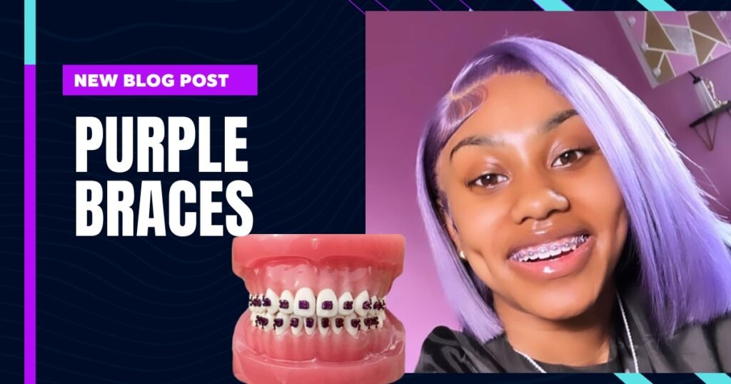 Thinking About Purple Braces? Here’s Why They’re the Best Choice for You! 2 Purple Braces