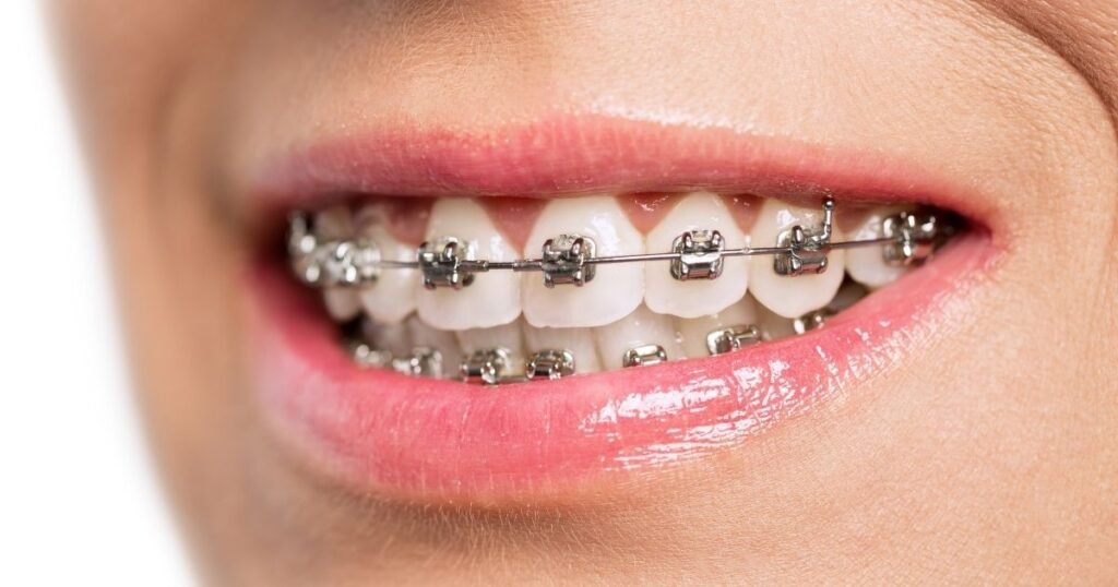Invisalign vs Braces? The Ultimate Guide to Choosing the Right Option in 2025! 4 Invisalign vs Braces