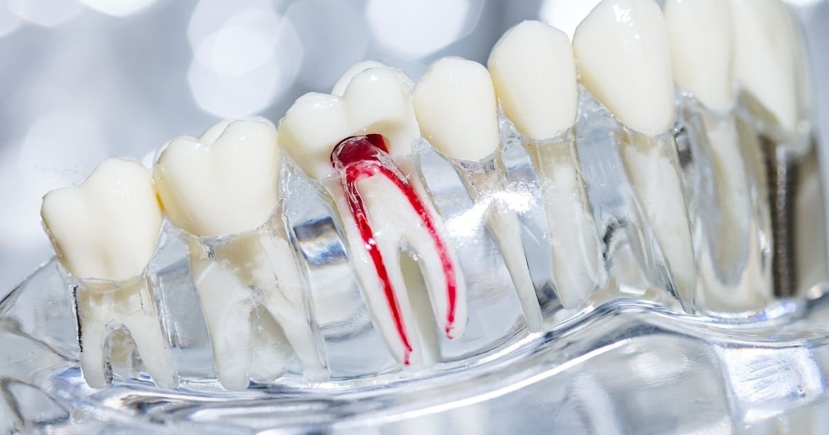 Invisalign vs Braces? The Ultimate Guide to Choosing the Right Option in 2025! 31 How common is root damage with Invisalign