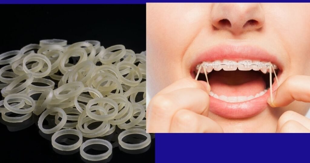 How Long Does It Take to Get Braces On? Step-by-Step Breakdown 7 How Long Does It Take to Get Braces On