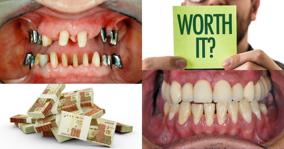 Full Mouth Dental Implants Cost in 2025: What You’ll Really Pay & How to Save Big 35 Is full mouth reconstruction worth it