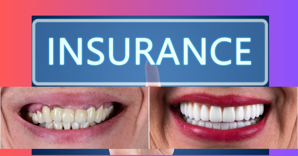 Full Mouth Dental Implants Cost in 2025: What You’ll Really Pay & How to Save Big 36 Is full mouth reconstruction covered by insurance