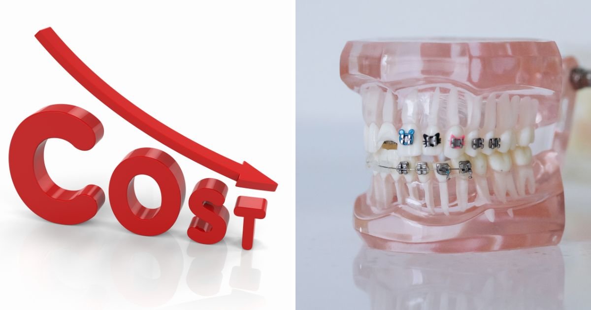 Invisalign vs Braces? The Ultimate Guide to Choosing the Right Option in 2025! 36 How much does Invisalign cost