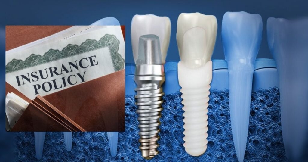 Zirconia Dental Implants Cost
