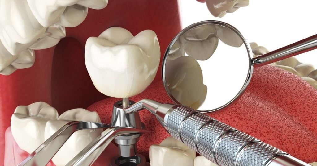 Endosteal Implants in 2025:Cost, Benefits & Step-by-Step Procedure Guide 6 Endosteal Implants