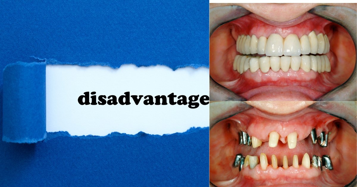 Full Mouth Dental Implants Cost in 2025: What You’ll Really Pay & How to Save Big 43 What are the disadvantages of full mouth rehabilitation