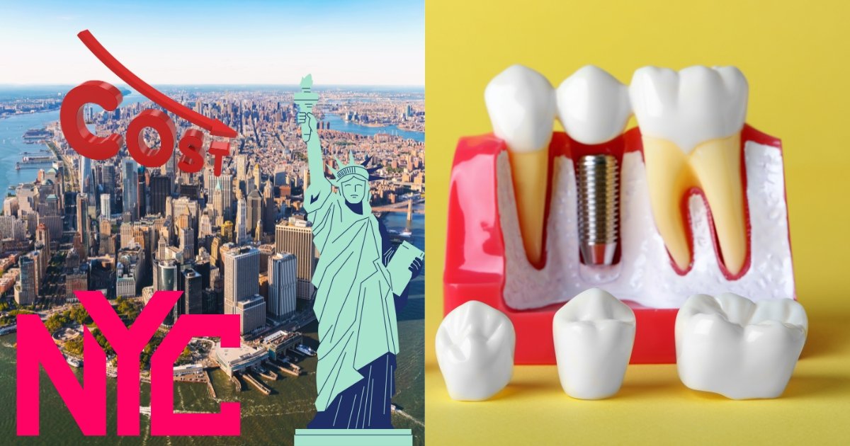 Full Mouth Dental Implants Cost in 2025: What You’ll Really Pay & How to Save Big 44 How much do implants cost in NYC