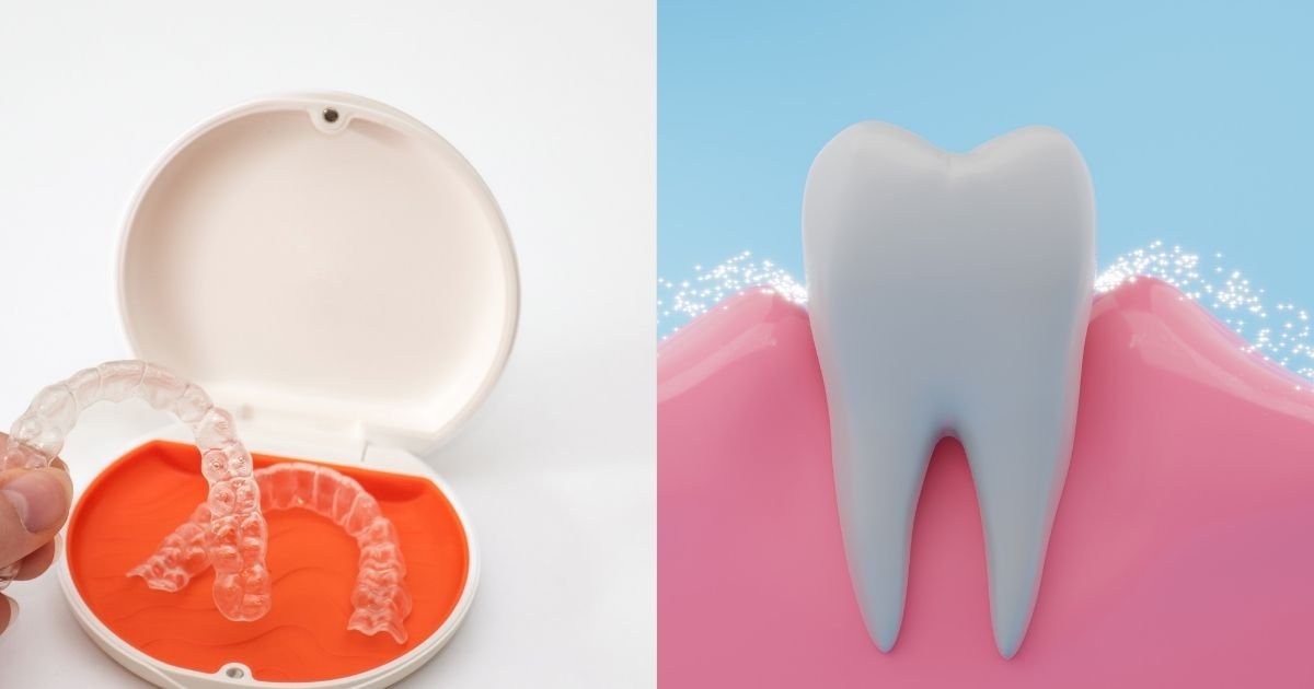 Invisalign vs Braces? The Ultimate Guide to Choosing the Right Option in 2025! 49 How can I straighten my teeth without braces