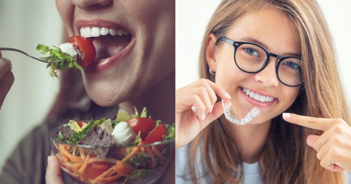 Invisalign vs Braces? The Ultimate Guide to Choosing the Right Option in 2025! 53 Can you eat with Invisalign