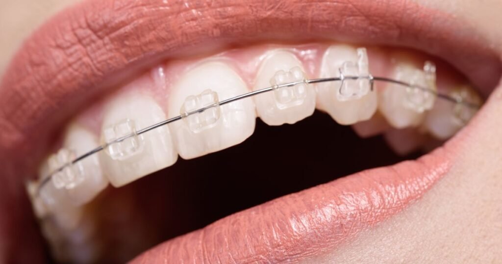 How Much Do Braces Cost in 2025? A Complete Price Breakdown 6 How Much Do Braces Cost
