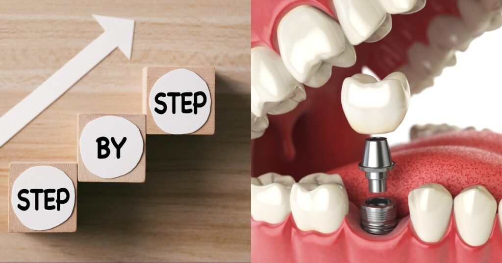 Full Mouth Dental Implants Cost in 2025: What You’ll Really Pay & How to Save Big 8 Full Mouth Dental Implants Cost