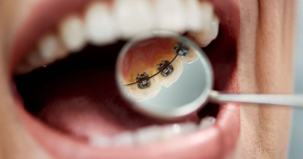 How Much Do Braces Cost in 2025? A Complete Price Breakdown 7 How Much Do Braces Cost