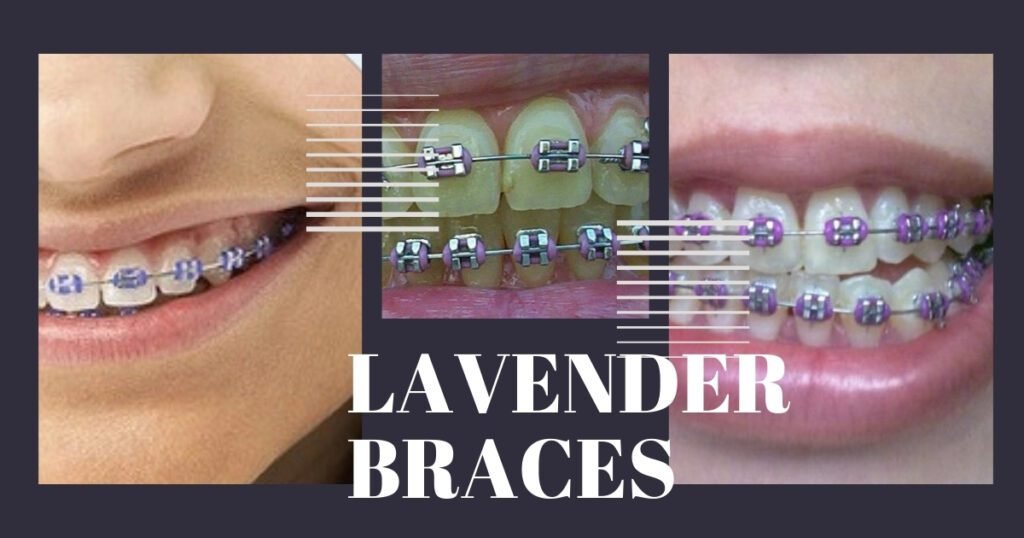 Lavender Braces