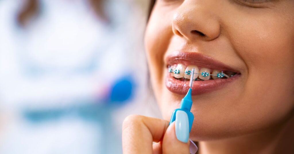 How Much Do Braces Cost in 2025? A Complete Price Breakdown 8 How Much Do Braces Cost