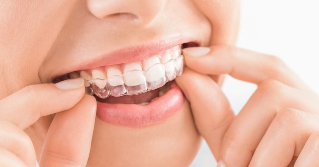 How Much Do Braces Cost in 2025? A Complete Price Breakdown 9 How Much Do Braces Cost