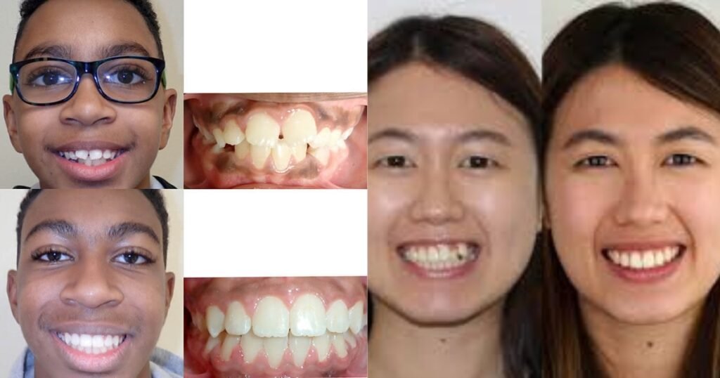 Before and After Braces: A Complete Transformation Guide 6 Before and After Braces