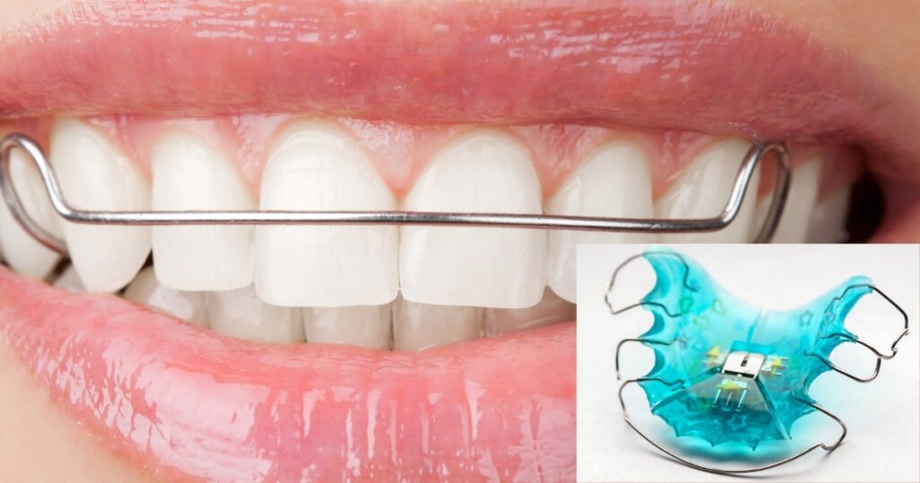 Before and After Braces: A Complete Transformation Guide 7 Before and After Braces