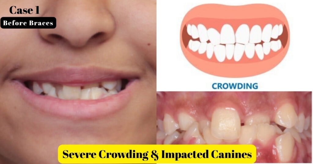 Before and After Braces: A Complete Transformation Guide 9 Before and After Braces