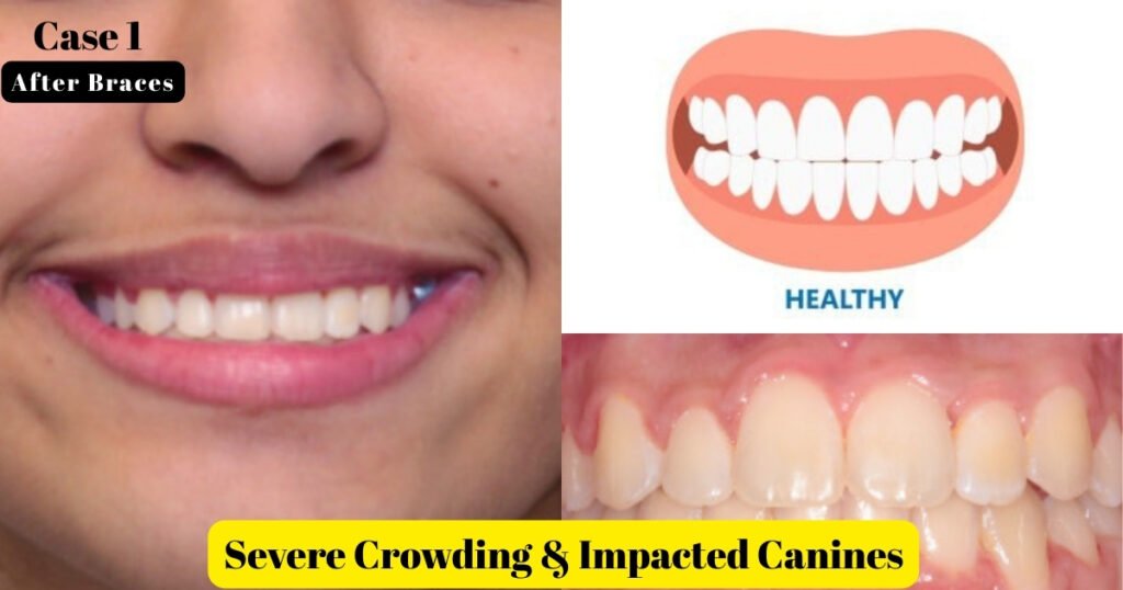 Before and After Braces: A Complete Transformation Guide 10 Before and After Braces