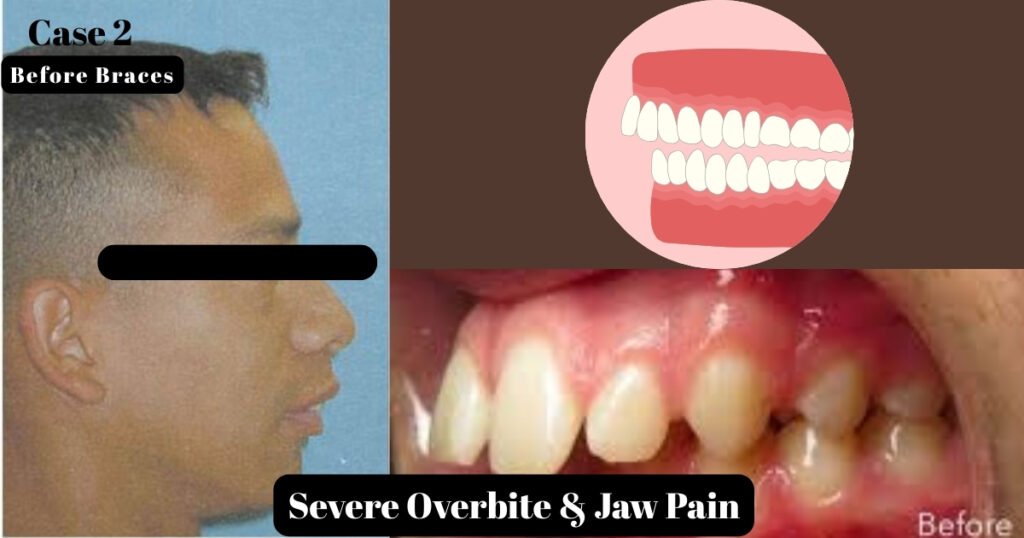 Before and After Braces: A Complete Transformation Guide 11 Before and After Braces