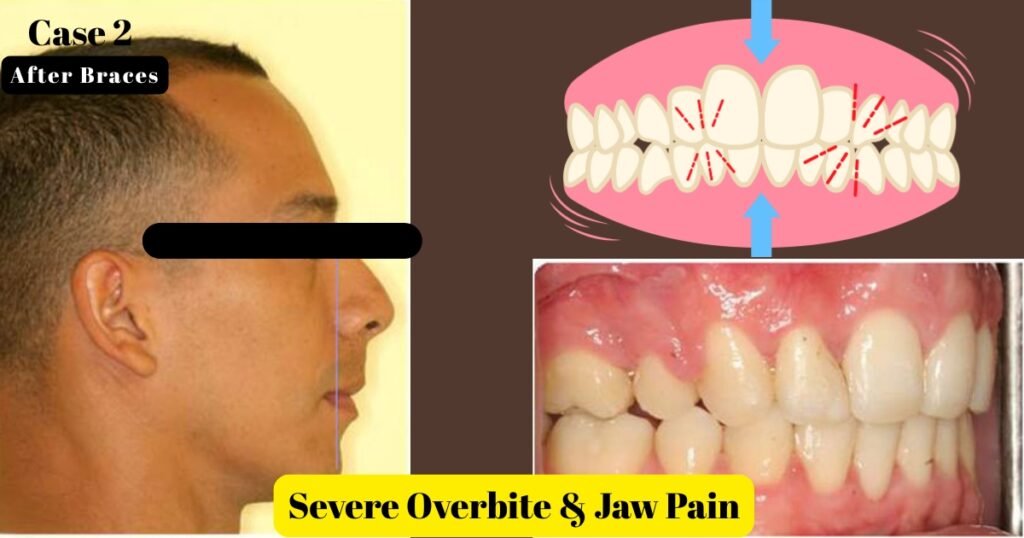 Before and After Braces: A Complete Transformation Guide 12 Before and After Braces