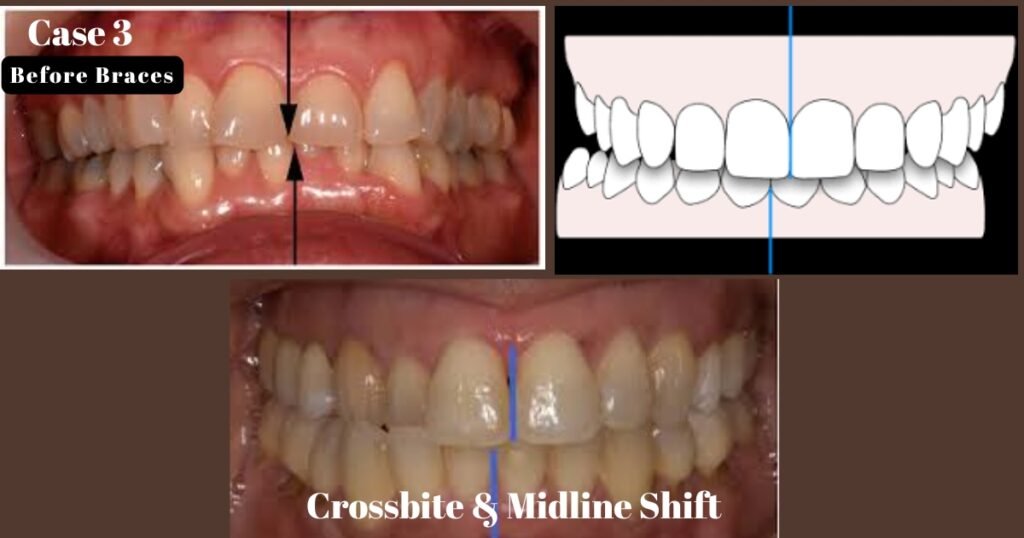 Before and After Braces: A Complete Transformation Guide 13 Before and After Braces