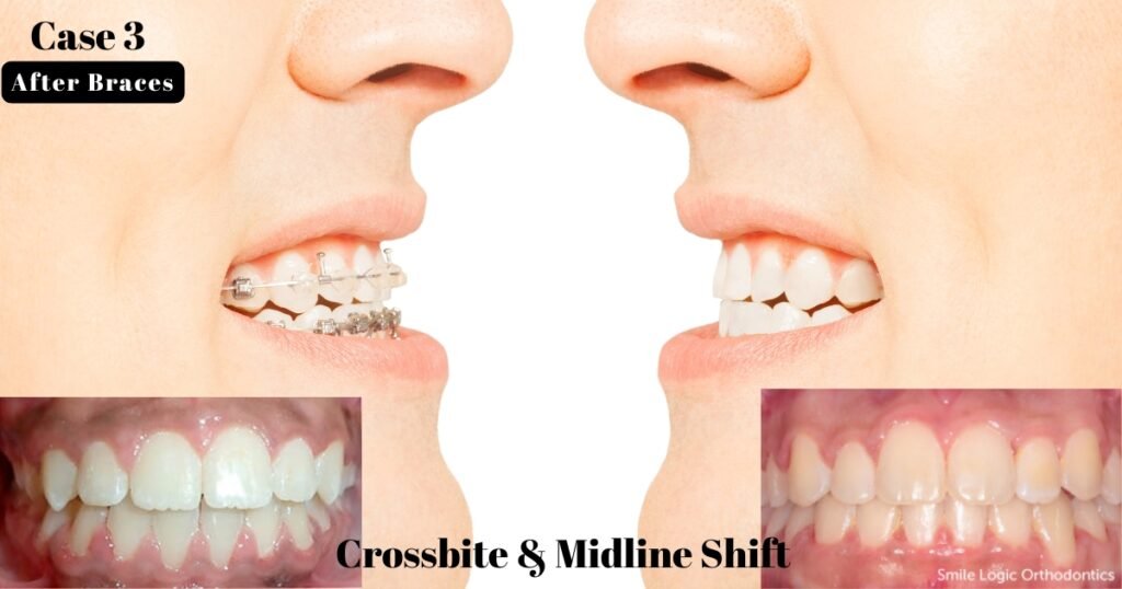 Before and After Braces: A Complete Transformation Guide 14 Before and After Braces