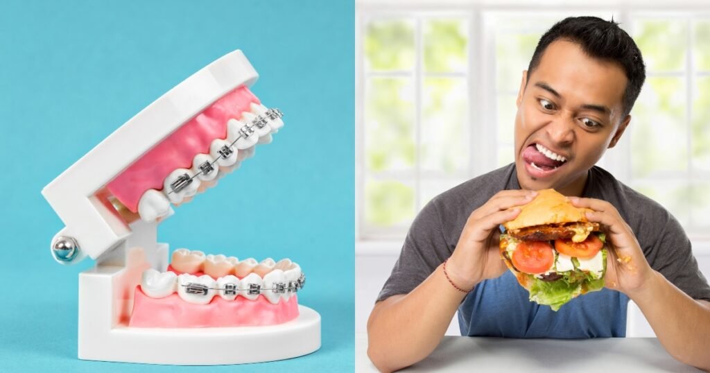 Can You Eat a Burger with Braces? 5 Tips to Enjoy Without Worry 3 Can You Eat a Burger with Braces