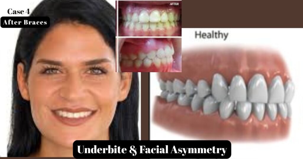 Before and After Braces: A Complete Transformation Guide 16 Before and After Braces