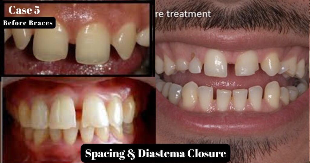 Before and After Braces: A Complete Transformation Guide 17 Before and After Braces
