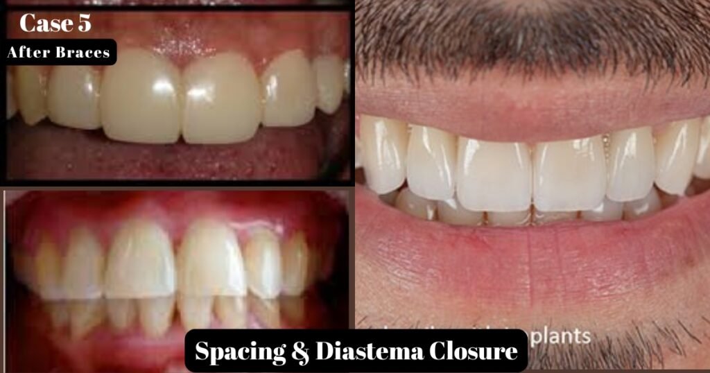 Before and After Braces: A Complete Transformation Guide 18 Before and After Braces