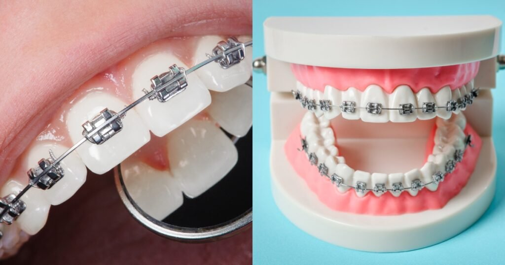Silver Braces: Why They’re Still a Popular Choice for Straightening Teeth 3 Silver Braces